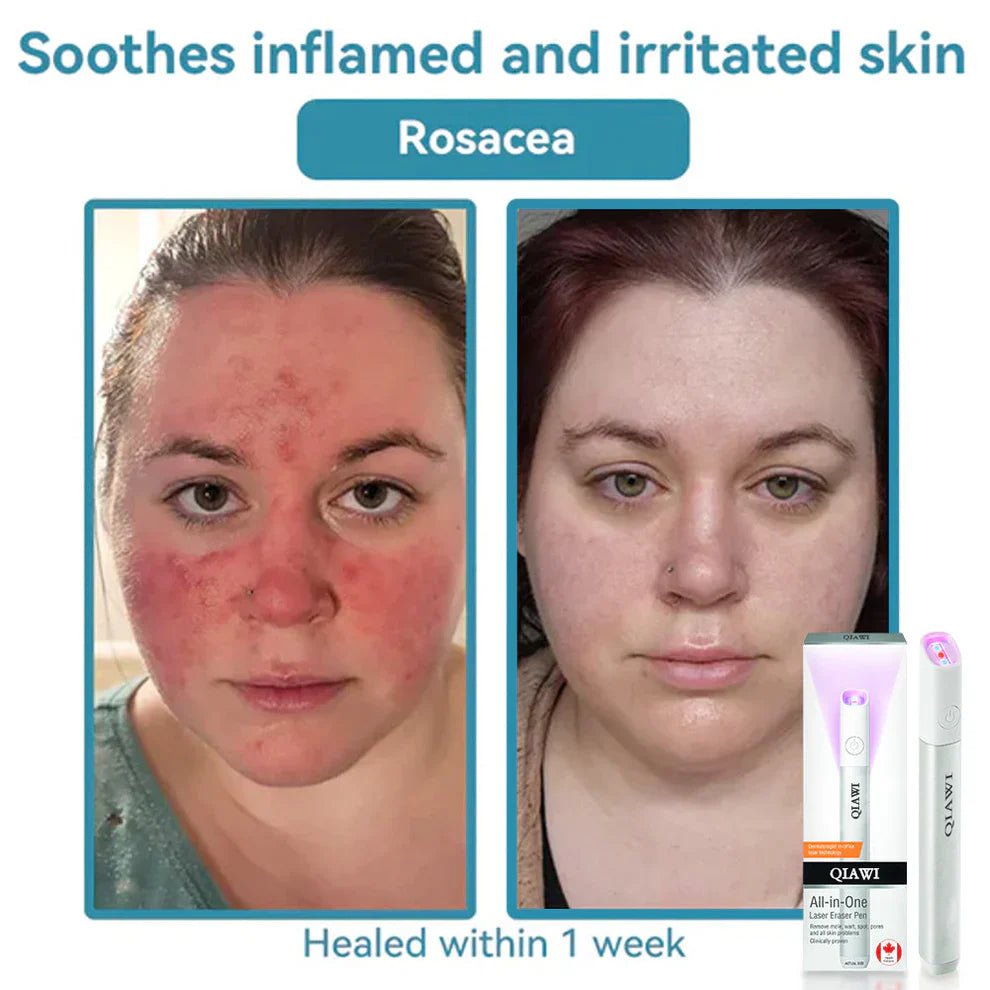 đĽQIAWI⢠All-in-One COâ Laser Eraser Pen | Removes Moles, Warts, Skin Flaws & Pigmentation