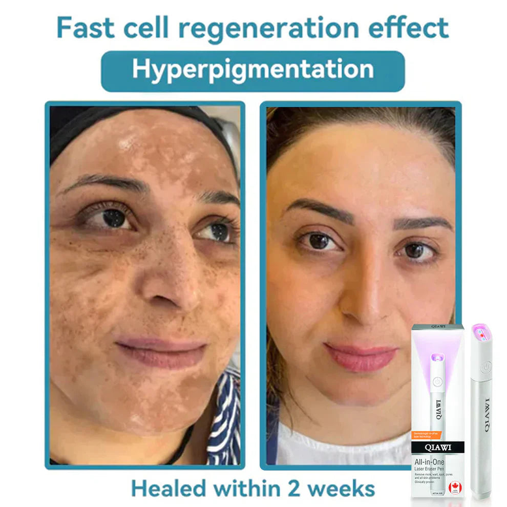 đĽQIAWI⢠All-in-One COâ Laser Eraser Pen | Removes Moles, Warts, Skin Flaws & Pigmentation