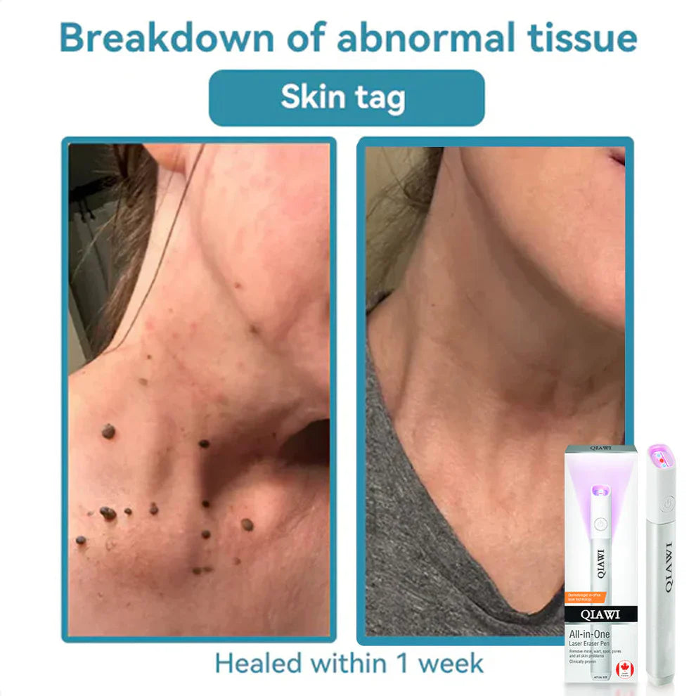 đĽQIAWI⢠All-in-One COâ Laser Eraser Pen | Removes Moles, Warts, Skin Flaws & Pigmentation