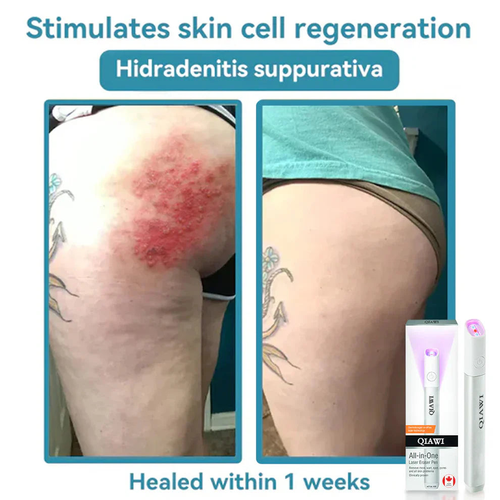đĽQIAWI⢠All-in-One COâ Laser Eraser Pen | Removes Moles, Warts, Skin Flaws & Pigmentation