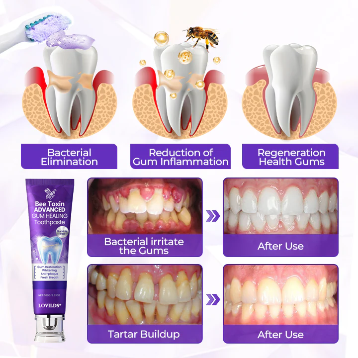 ✨LOVILDS® BeeToxin Advanced Gum Healing Toothpaste✨