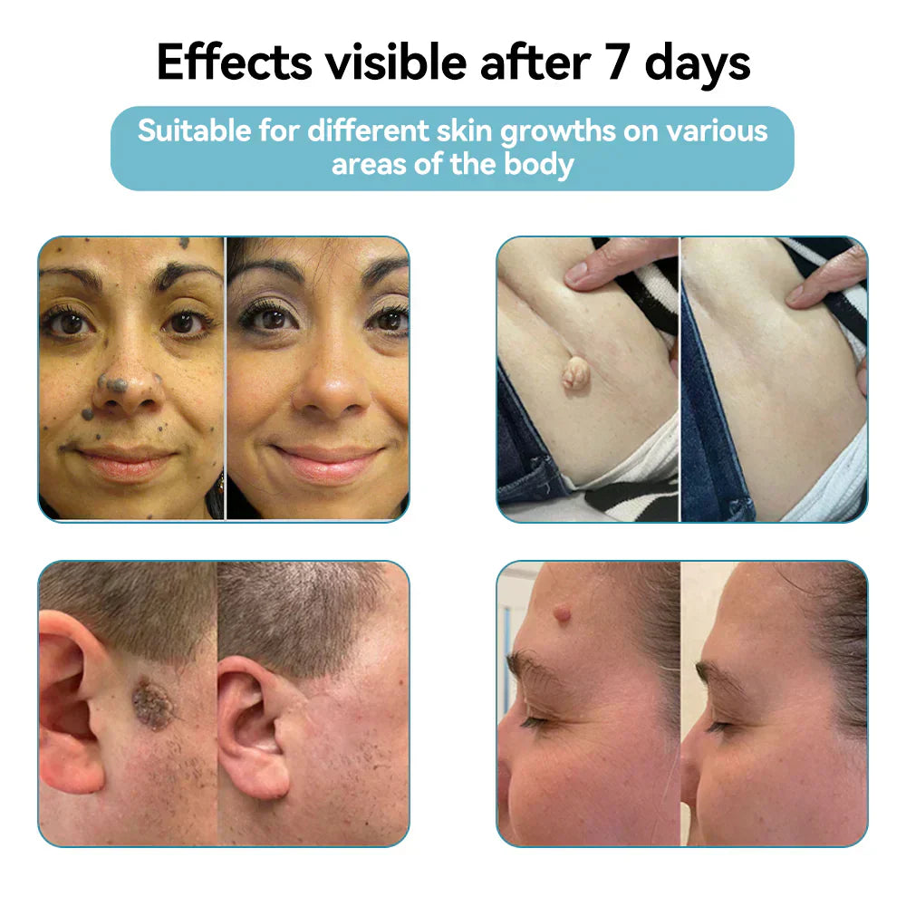 đĽQIAWI⢠All-in-One COâ Laser Eraser Pen | Removes Moles, Warts, Skin Flaws & Pigmentation