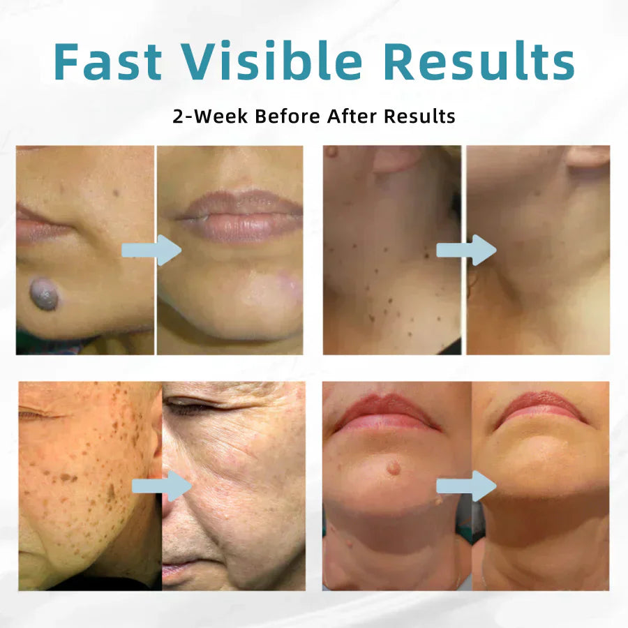 đĽQIAWI⢠All-in-One COâ Laser Eraser Pen | Removes Moles, Warts, Skin Flaws & Pigmentation